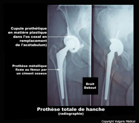 Prothèse totale de hanche (radiographie)