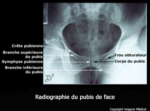 Pubis (radiographie de face)