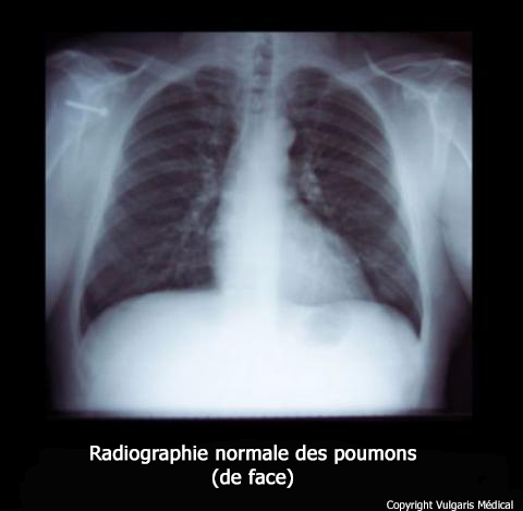 Radiographie normale des poumons de face