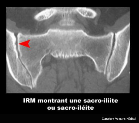 Sacro-iliite (IRM)