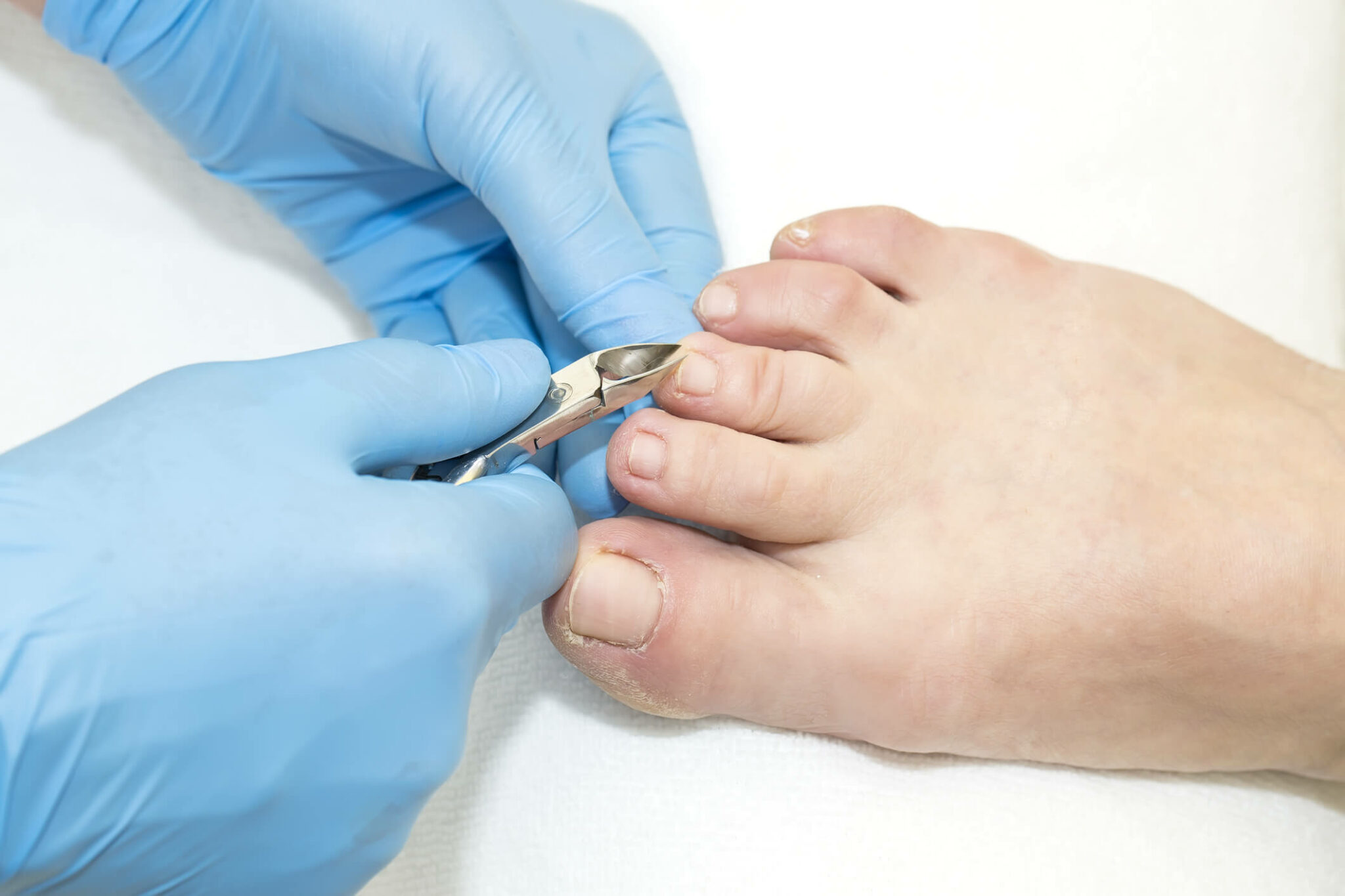 comment-bien-couper-ses-ongles-vulgaris-medical