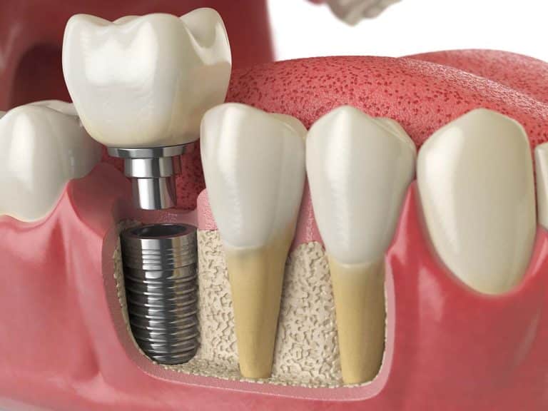 implant dentaire envato