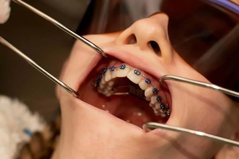 orthodontie adulte photo presentation