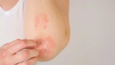 eczema atopique zoom sur cette condition peau